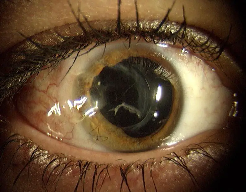 an eye that has been injured by a BB